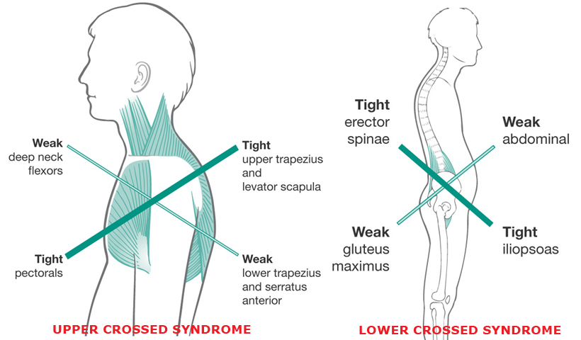 Bättre hållning - Upper Crossed Syndrome